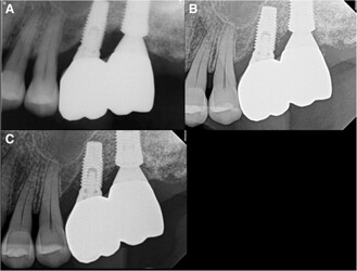 sinus_failure_3