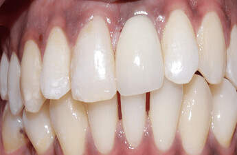 Customized abutment