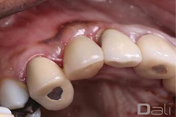 dali_flex_graft_2year_follow_up