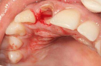 vertical sectioning of the root