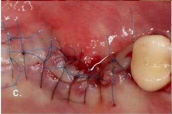 tensionless suturing