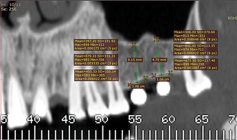 Showing pre-operative bone density analysis