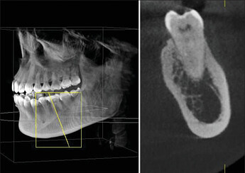 cbct-case2-1