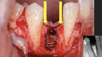 osteotomy and implant placement with nice bone peaks