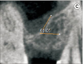 CBCT showing buccopalatal sinus width measured at 10.00 mm from the alveolar crest.
