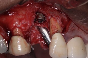 implant placement