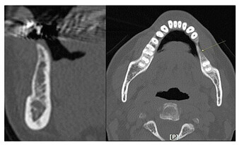 CBCT, preoperative view.