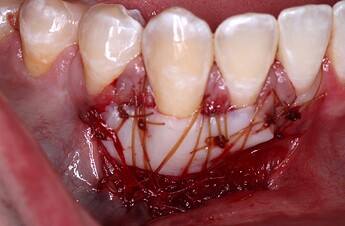 gingival_graft_3