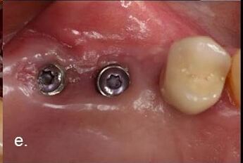 clinical situation 6 months after