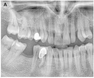 Right mandibular first premolar with periapical pathology.