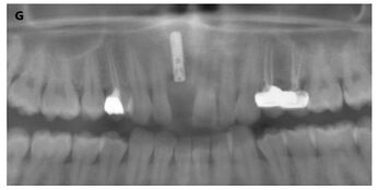 Postoperative radiography