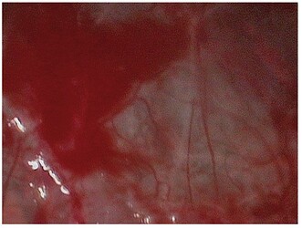 Sinus membrane integrity as established by endoscopy.