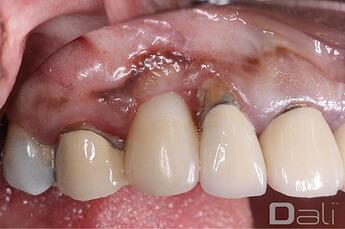 dali_flex_graft_1b_2_year_follow_up