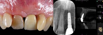 Clinical and radiographic (2D, 3D) follow up at 1 year. 2D, two-dimensional; 3D, three-dimensional.