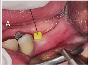 soft tissue thickness