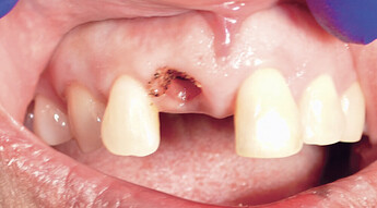 gingival recontouring was completed