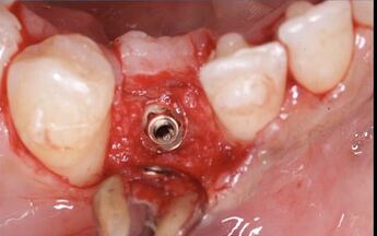 bone was removed with bur to reveal the restorative platform