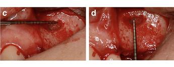 The Schneiderian membrane was then gently elevated