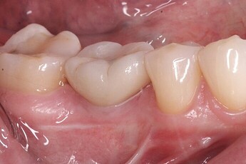 great increase in tissue contour
