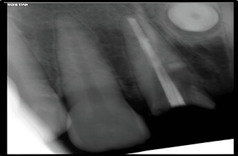 root canal treated 21