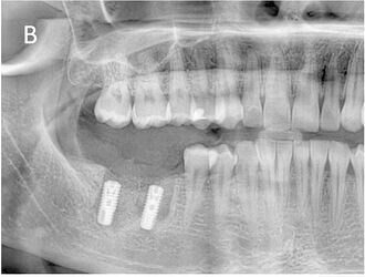 Extraction of teeth, placement of immediate implants and filling of socket cavities with guided bone regeneration (1st postoperative week)