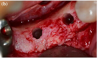 tunneling technique with membrane