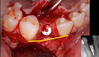 implant well within alveolar housing