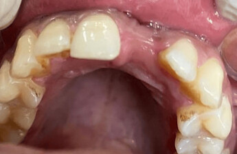 Preoperative intra-oral image