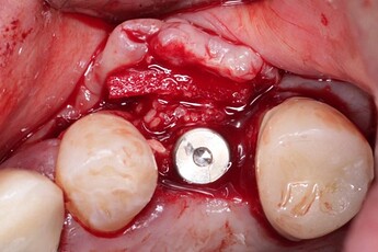DALI ADM was used instead of a membrane in order to add tissue thickness as well.