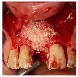 Immediate implant placement and grafting of the area.