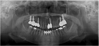 sinus_failure_4