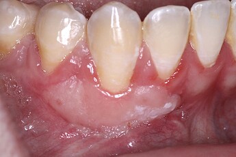 gingival_graft_4