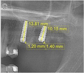 2 months after placement of the implants
