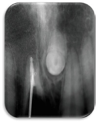 root resection.