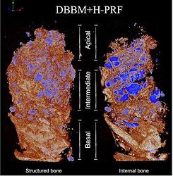 3D Micro‐CT images DBBM with H-PRF