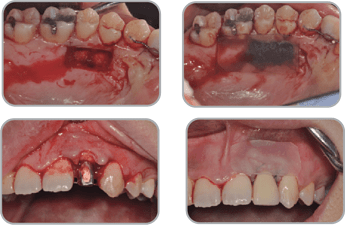 Subepithelial connective graft