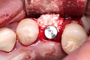 the site was augmented simultaneously with DALI Classic Bone Particulate and DALI Dermis ADM