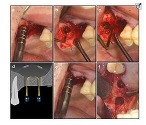 Schneiderian membrane elevation. (a ) using osteotome to elevate the sinus membrane (>1 mm). (b ) using dome-shaped sinus curette to lift the membrane. (c ) using variously shaped detachers in Dentium Advanced Sinus Kit (DASK) to detach the membrane. (d ) using detachers to elevate the membrane between 2 implants. (e ) using osteotome to ascertain the height of elevation. (f ) integrated membrane after elevation.