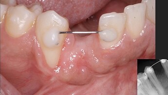 missing 27 failed implant site