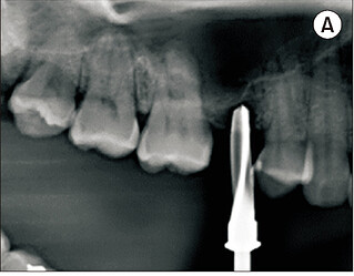 Osteotomy prepared to a depth of 3.5 mm