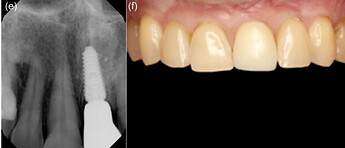 Peri‐apical radiograph