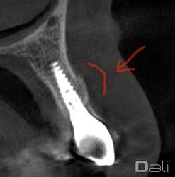 dali_flex_graft_xray