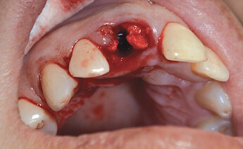 Hahn™ Tapered Implant placed with graft filling gap