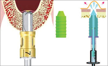This is a schematic diagram as given by the Hiossen for Crestal Sinus Lift Kit. The left side picture is the safe drill perforating the sinus. The right side shows the waterjet as hydraulic pressure which can lift the sinus membrane