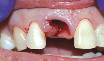 gaps between the implant body and the alveolus