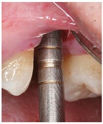 Controlled fracture of the floor of the maxillary sinus using an osteotome.