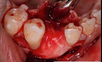 osseoseal membrane contouring around graft material