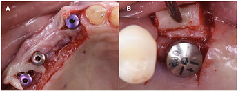 soft_tissue_1_flap