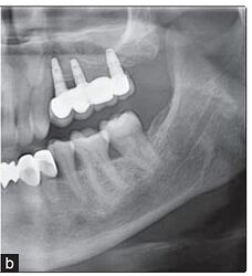 After prosthetic rehabilitation following indirect sinus lift
