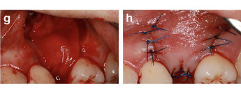 regenerative material placed